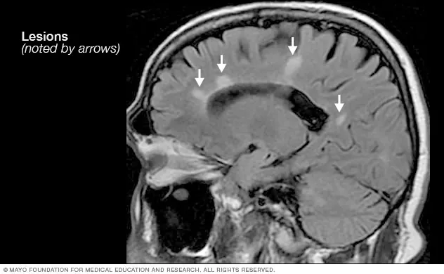 مسح رنين مغناطيسي لدماغ يظهر آفات بيضاء مرتبطة بالتصلب اللويحي (Mayo Clinic)
