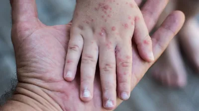 جدري القردة وباء جديد يجتاح العالم.. ماذا نعرف عنه؟